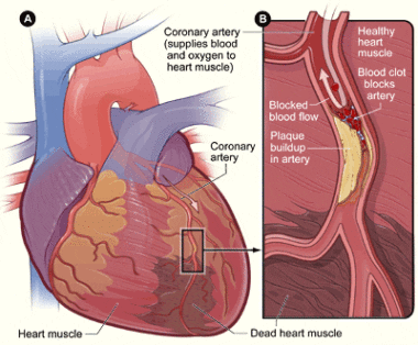 Heart_attack-NIH
